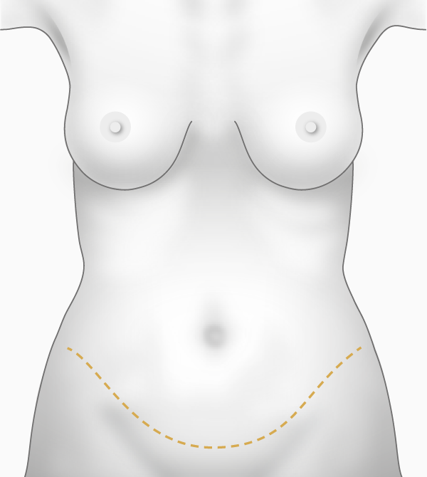 Abdominoplastie, cicatrices