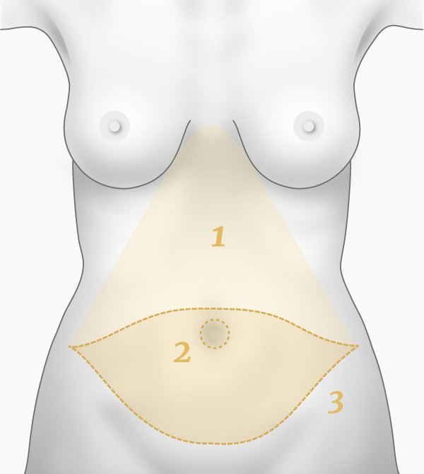 Abdominoplastie, principe