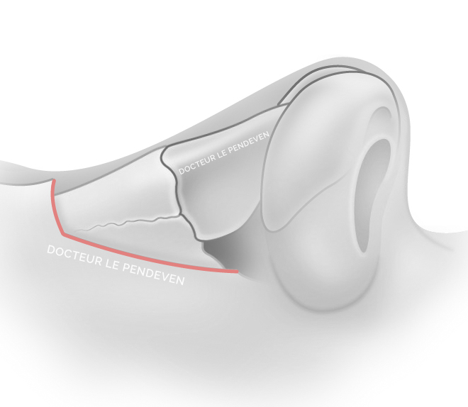 illustration 'Impaction de la bosse'