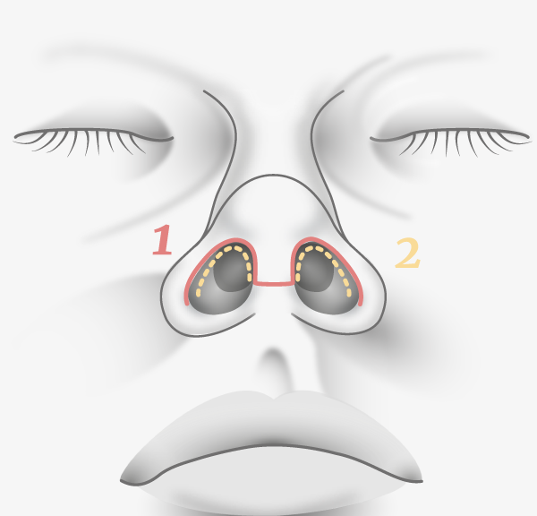 Rhinoplastie, cicatrices