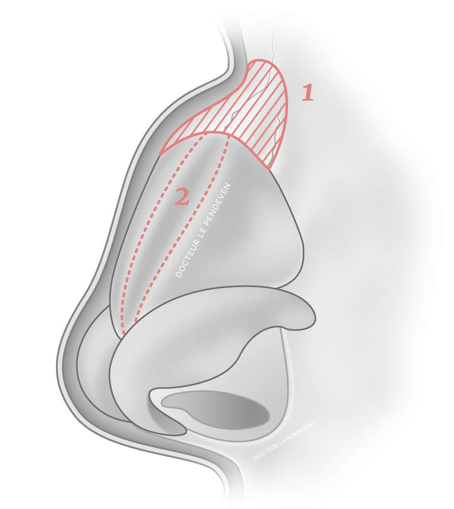 illustration 'Traitement d'une bosse en Spreader Flap'