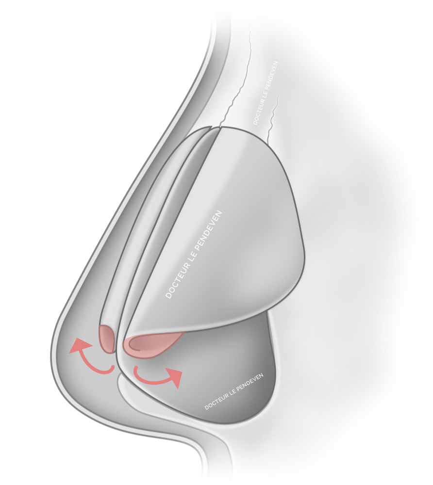 illustration 'Traitement d'une bosse en Spreader Flap'