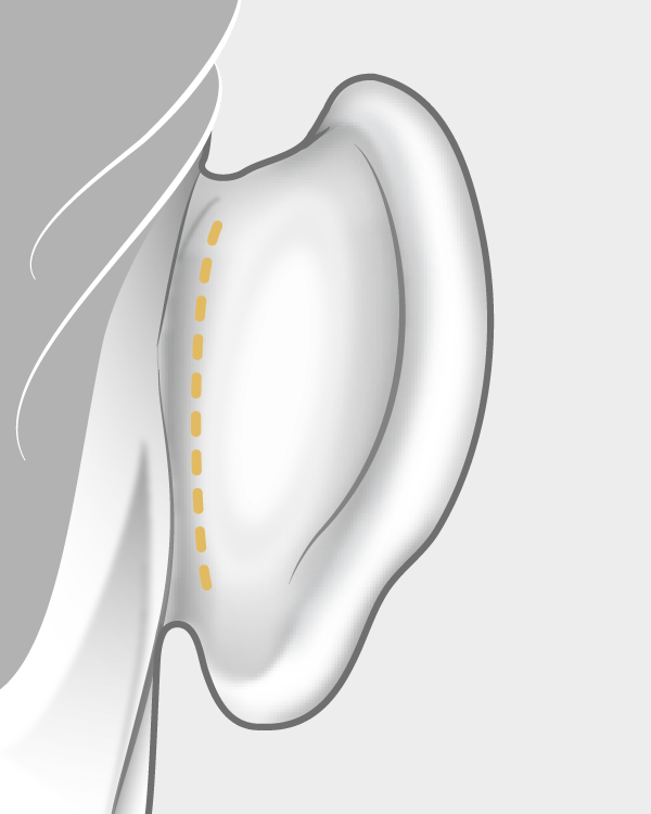 Otoplastie cicatrices