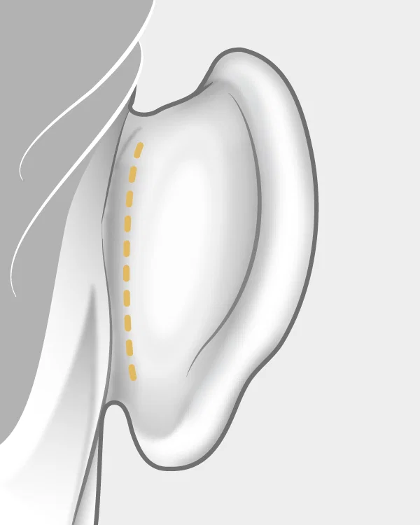 Illustration otoplastie cicatrices
