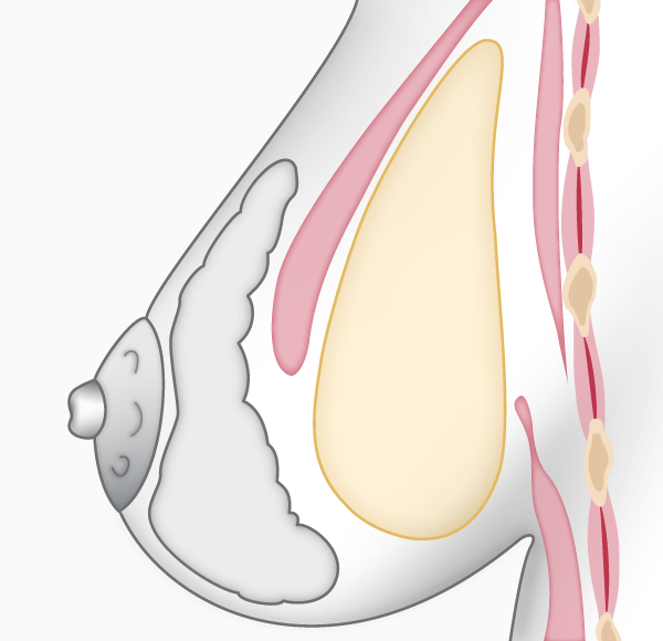 Augmentation mammaire, prothèse en arrière du muscle