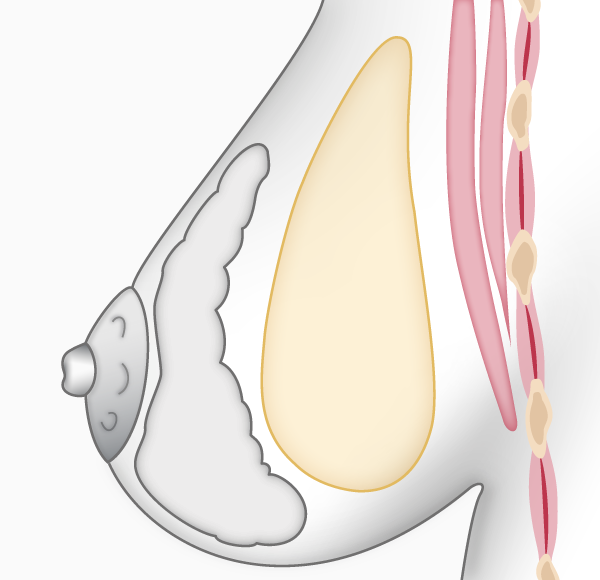 Augmentation mammaire, prothèse en avant du muscle