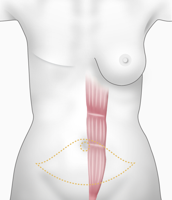 Prélèvement du muscle 'grand droit' de l'abdomen