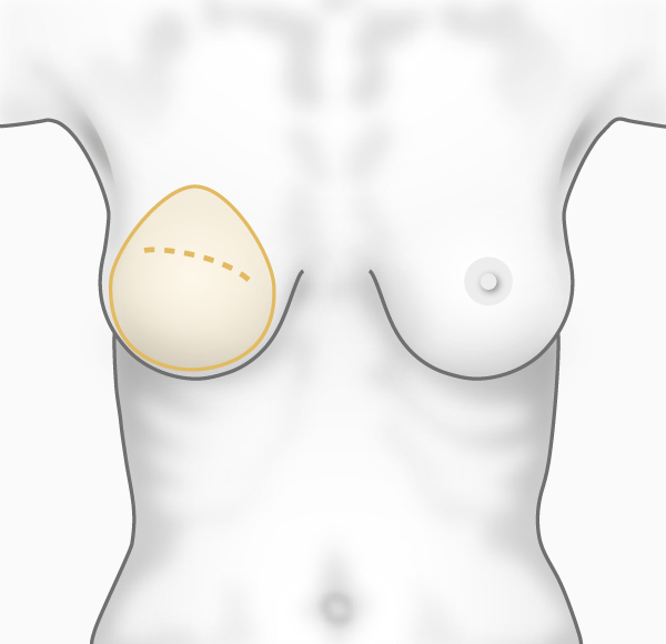 Technique de reconstruction du sein par prothèse