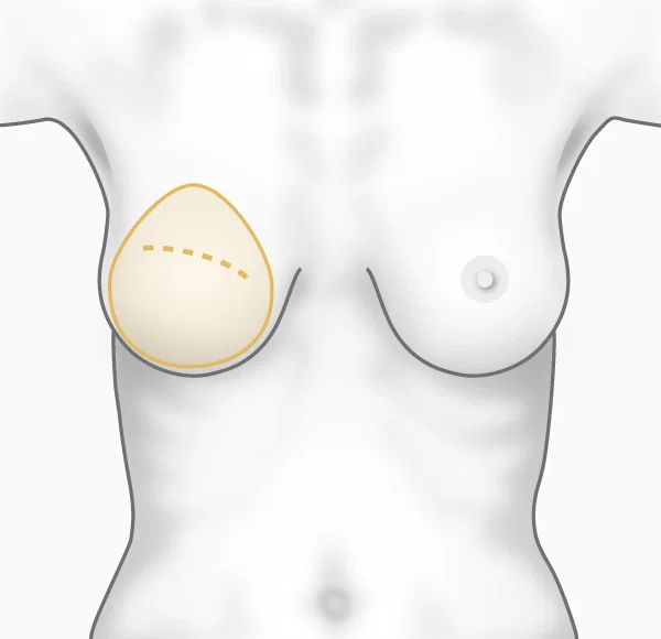Illustration de la technique de reconstruction du sein par prothèse