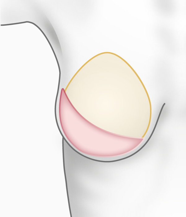 Reconstruction du sein par muscle grand dorsal et prothèse