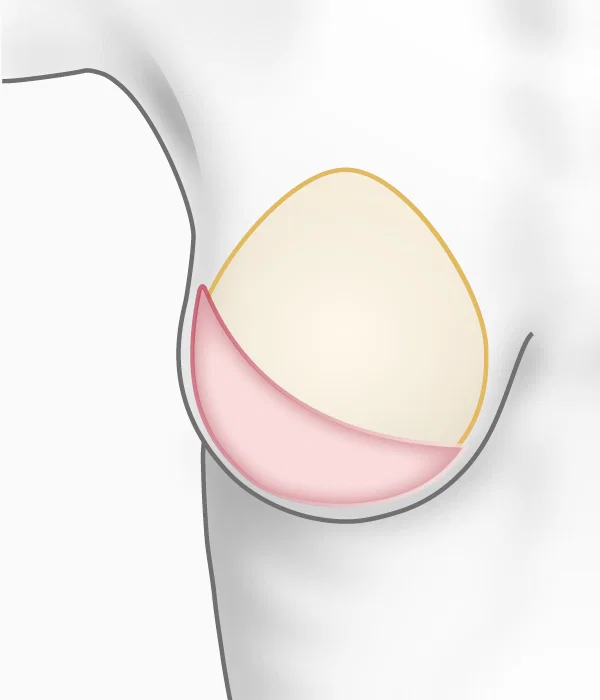 Illustration de la reconstruction du sein par muscle 'grand dorsal' et prothèse