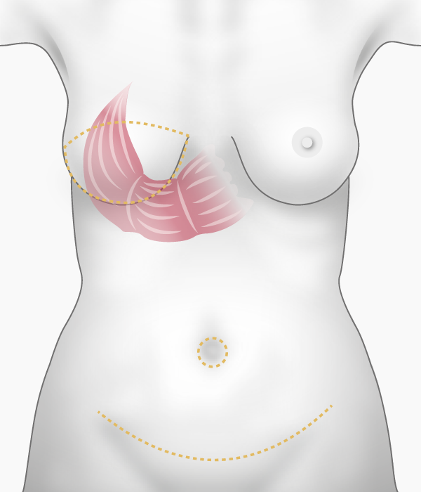 Reconstruction du sein par muscle grand droit de l'abdomen