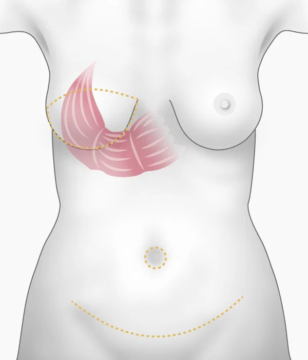 Illustration de la reconstruction du sein par muscle 'grand droit' de l'abdomen