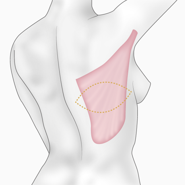 Prélèvement du muscle 'grand dorsal'