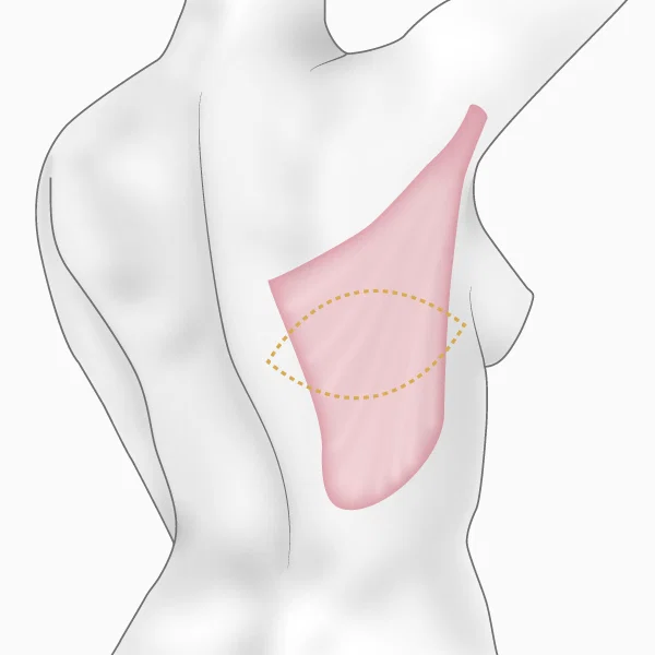 Illustration du prélèvement du muscle 'grand dorsal'