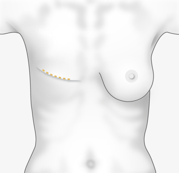 Incision pratiquée sur la cicatrice de la mastectomie