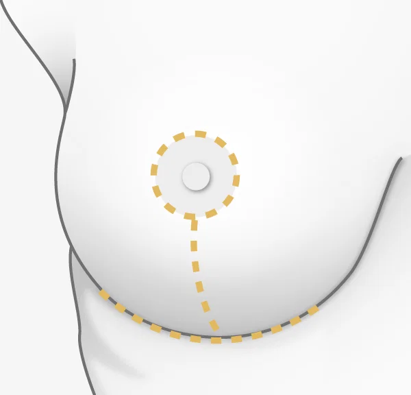 Illustration chirurgie mammaire, technique à trois cicatrices