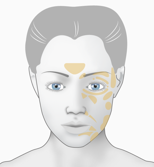 Toxine botulique, zones d'injection