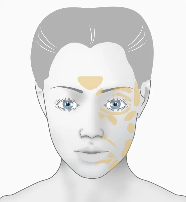 Illustation acide hyaluronique, zones d'injection